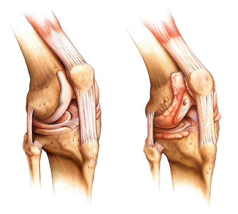 Zdrowy staw (po lewej) i staw artretyczny (po prawej)