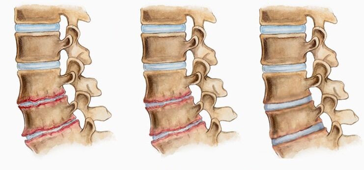 Deformacja krążków międzykręgowych w osteochondrozie może powodować ból pleców