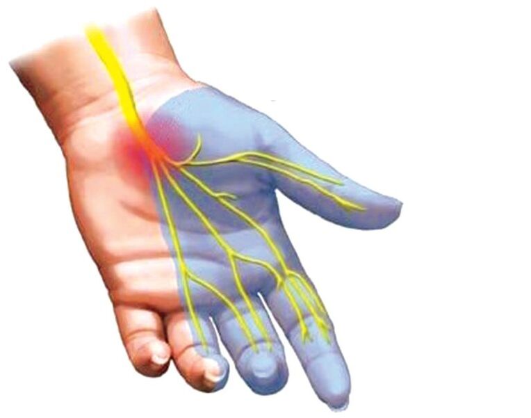 drętwienie dłoni z osteochondrozą