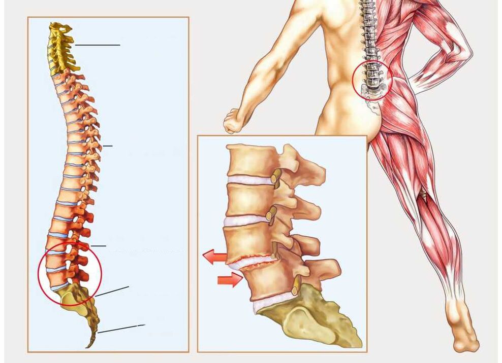 zdrowy i chory kręgosłup